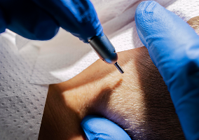 sac mezoterapisi cozumleri